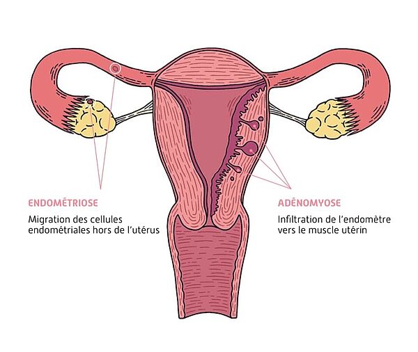 Schéma de l'endométriose (source : Endofrance) - Agrandir l'image (fenêtre modale)