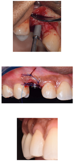 chirurgie visant à implanter une dent
