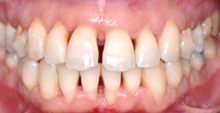 gencives blanches et dents qui se déchaussent